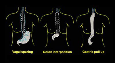 Esophagectomy | Memorial Hermann