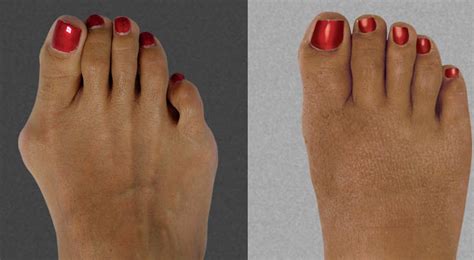 Bunion Surgery Before and After