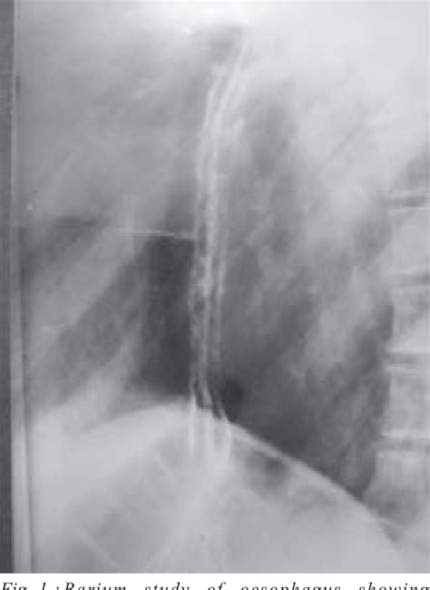 Figure 1 from Oesophageal Candidiasis in a HIV Infected Patient | Semantic Scholar