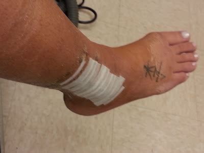 My Broken Ankle =(: Cast Removal Day!