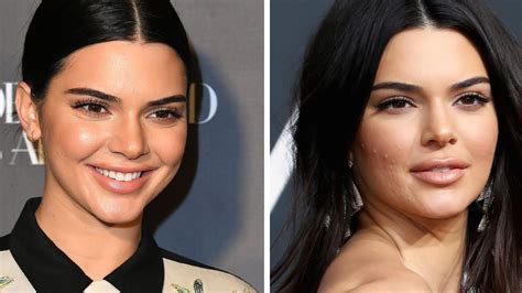 Did Kendall Jenner Get Lip Injections - Kendall Jenner's Lips at the ...