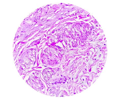 Prepatellar Region Histology Showing Bursitis, Acute or Chronic ...