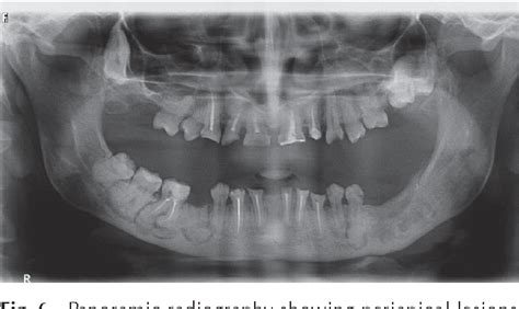 Figure 1 from Familial gigantiform cementoma with Ehlers - Danlos syndrome: A report of 2 cases ...