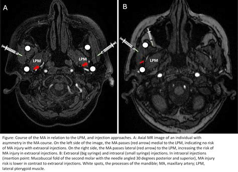 Approaching the lateral pterygoid muscle in botulinum toxin injections ...