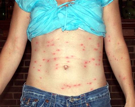 Chigger Bites | Chigger Bite | Chigger Bite Pictures | Chigger Bite Treatment | Diseases Pictures