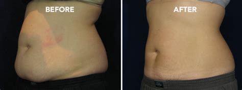 CoolSculpting Kelowna - Non Surgical Liposuction Alternative