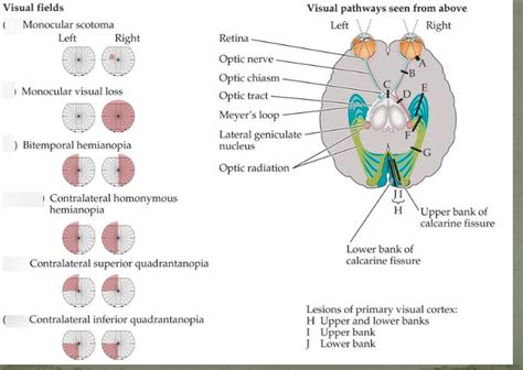 Lesions of primary visual pathway Diagram | Quizlet