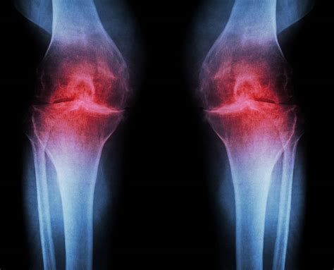 What are the stages of osteoarthritis and their treatments – Eureka Wellbeing