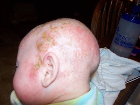 Baby cradle cap pictures, symptoms, causes, and treatments ...