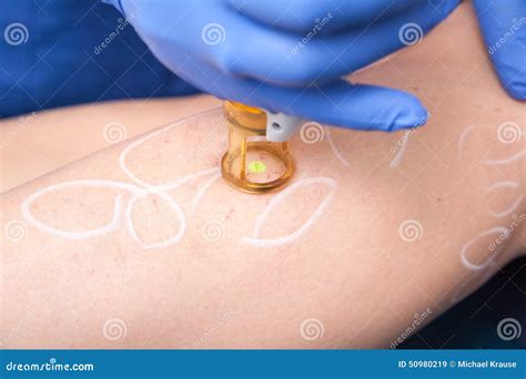 Spider vein medical laser stock image. Image of veins - 50980219