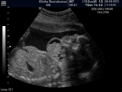 A longitudinal scan of a fetus with a neck teratoma | Download Scientific Diagram