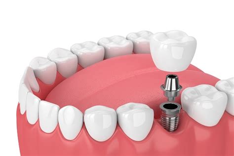 Dental Implants - Cosmetic Dentistry for Missing Teeth