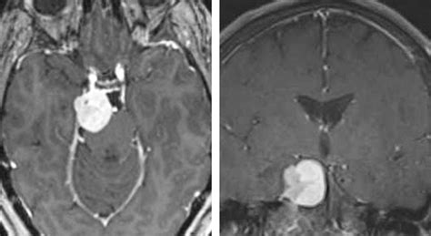 Petroclival Meningioma | Expert Surgeon | Aaron Cohen-Gadol MD