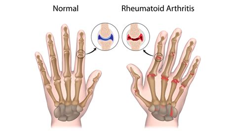 Rheumatoid Arthritis - Arthritis Treatment Center