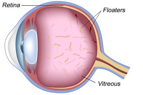 Black Spot In Eye Ball