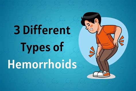 3 Different Types of Hemorrhoids