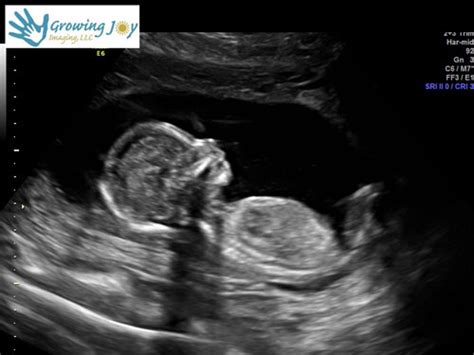 OB Diagnostic Ultrasound