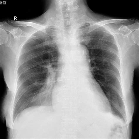 Chest X‐ray obtained 4 days after the contrast agent injection. This... | Download Scientific ...