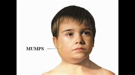 Biggest mumps outbreak in 22 years occurring in Texas | newswest9.com