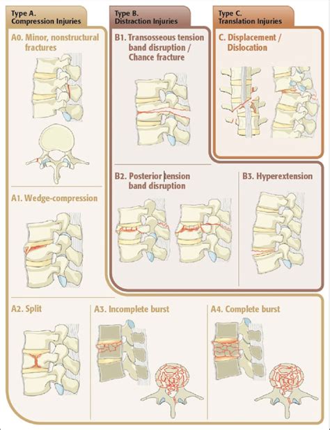 Ao Classification Spine Trauma