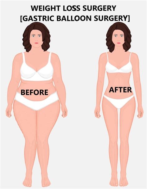 Weight Loss Surgery in India