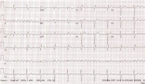 Atrial flutter EKG examples - wikidoc