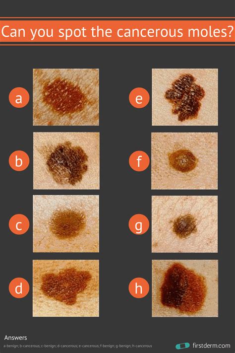 Can you spot the cancerous mole? - Online Dermatology | Cancerous moles, Skin moles, Mole