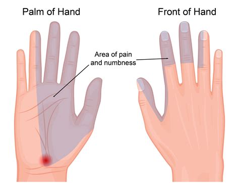 Carpal Tunnel Syndrome - Raleigh Hand Surgery — Joseph J. Schreiber, MD