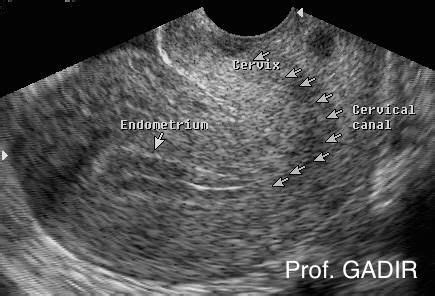 Anteverted Retroflexed Uterus | Ectopic pregnancy, Pregnancy ultrasound, Ultrasound pictures