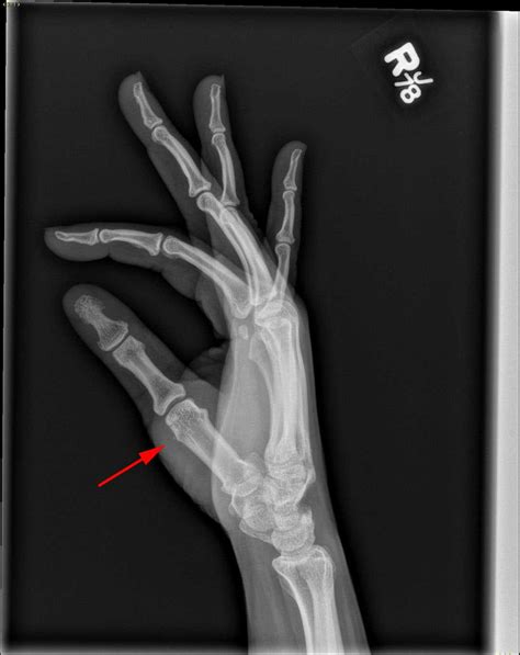 Radial collateral ligament avulsion - X Rays Case Studies - CTisus CT Scanning