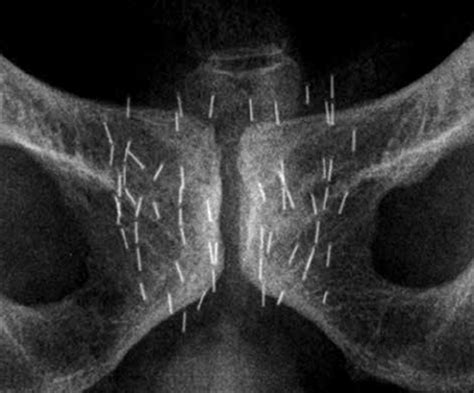 X-ray one month after the implant, with no displace- ment of seeds ...