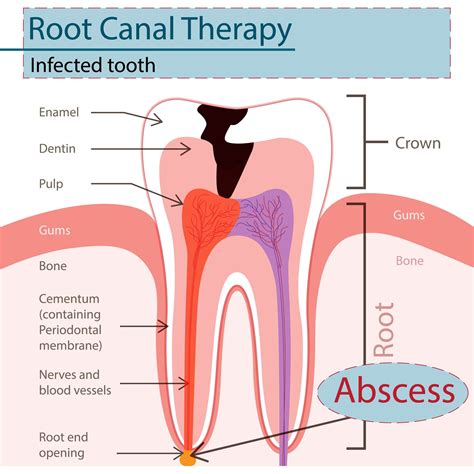 Root Canal Treatment — Klein Family Dental