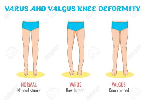 SAMARPAN PHYSIOTHERAPY FITNESS & REHAB. CLINIC: Knee Valgus Deformity ...