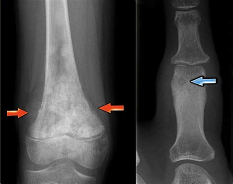 RadiologySpirit: osteoid matrix