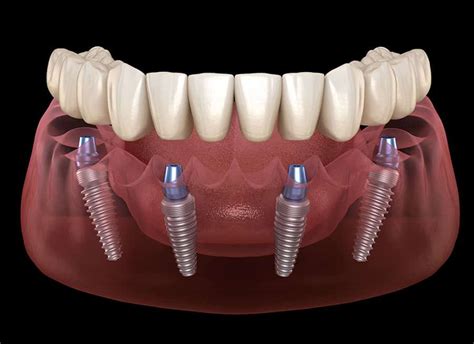 All on 4 Dental Implants: Is it Cheaper in Costa Rica?