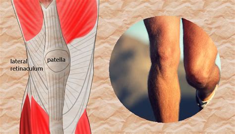 The lateral retinaculum and lateral release | KNEEguru