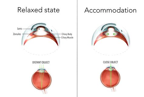 Congenital cataract: for patients - Gene Vision