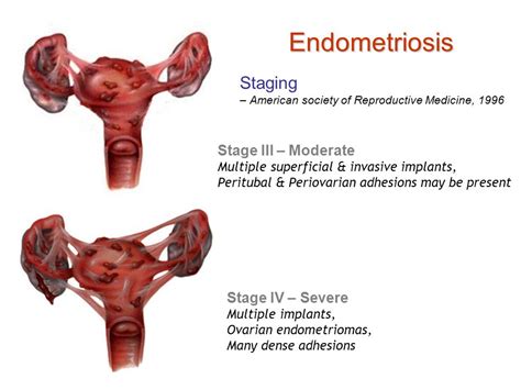 Endometriosis - International Women's Clinic