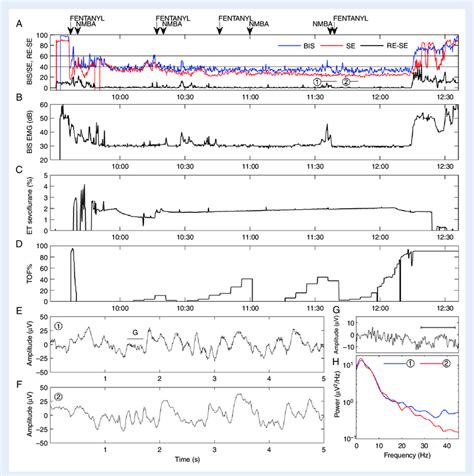 The effect of EMG activation on BIS (Bispectral Index®) and SE (State... | Download Scientific ...