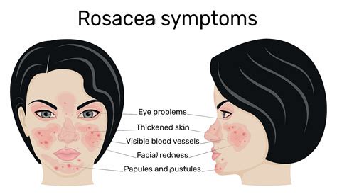 What Causes Itchy Rosacea And How To Soothe It - SL Aesthetic Clinic