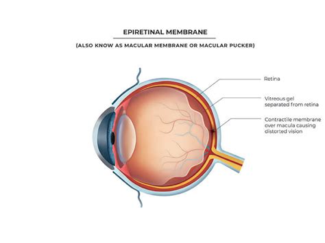 Epiretinal Membrane South Africa | Dr Steven Lapere | Ophthamologist