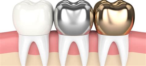 Dental Crowns: Types, Cost, Procedures, Advantages - Thornhill Dental Office