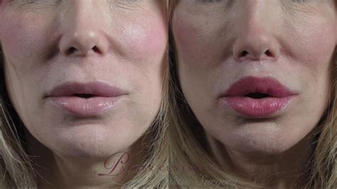 Non Surgical Lip Lift Before And After - Infoupdate.org