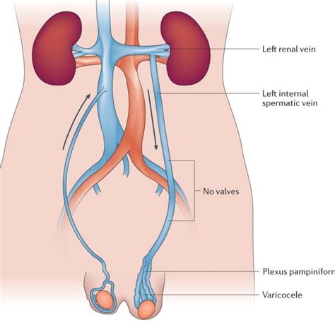 √ Varicocele - Varicocele agrandamiento de las venas en los testículos ...