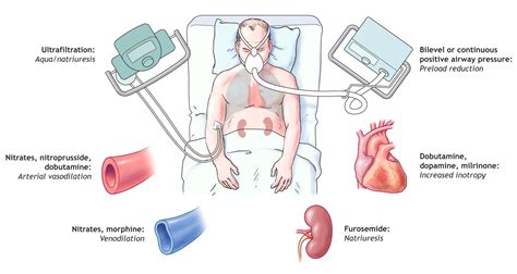 Cardiogenic Pulmonary Edema , Acute Heart failure