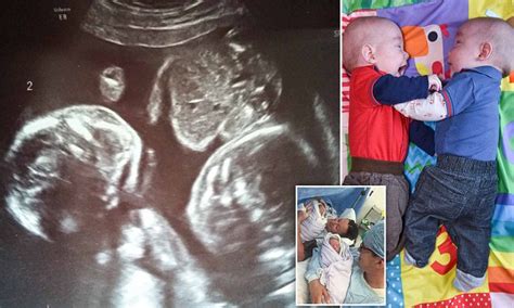 Identical twins pictured cuddling each other in the womb | Daily Mail Online