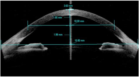 Anterior Segment Ocular Coherence Tomography (OCT) - Michigan College Of Optometry