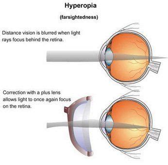 Hyperopia - Definition, Symptoms, Causes, Diagnosis, Treatment | Herbal remedies, Herbalism, Dry ...