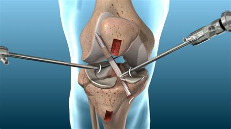 Posterior Cruciate Ligament | Knee Replacement Surgery