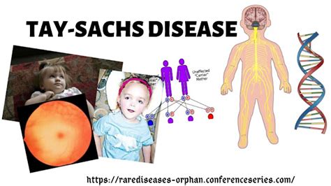 Read This Controversial blog And Find Out More About TAY-SACHS DISEASE